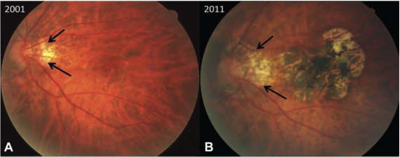 [MISSING IMAGE: tv506945_img-macular.jpg]